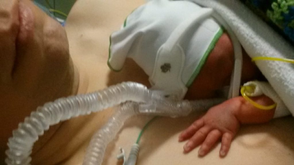Frühchen SSW 29, CPAP